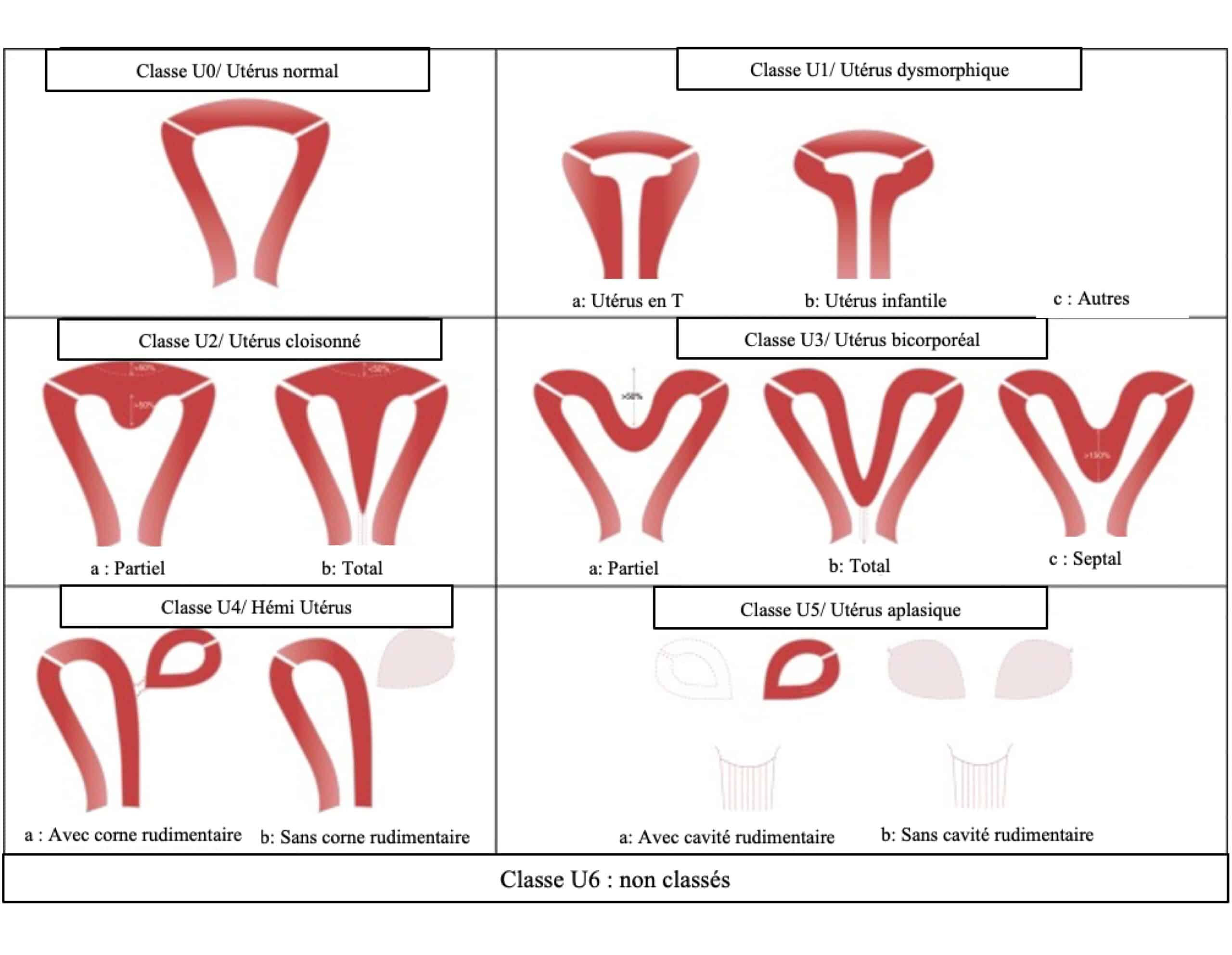 Malformation utérine Gynécologie et infertilité Dr Krief Paris